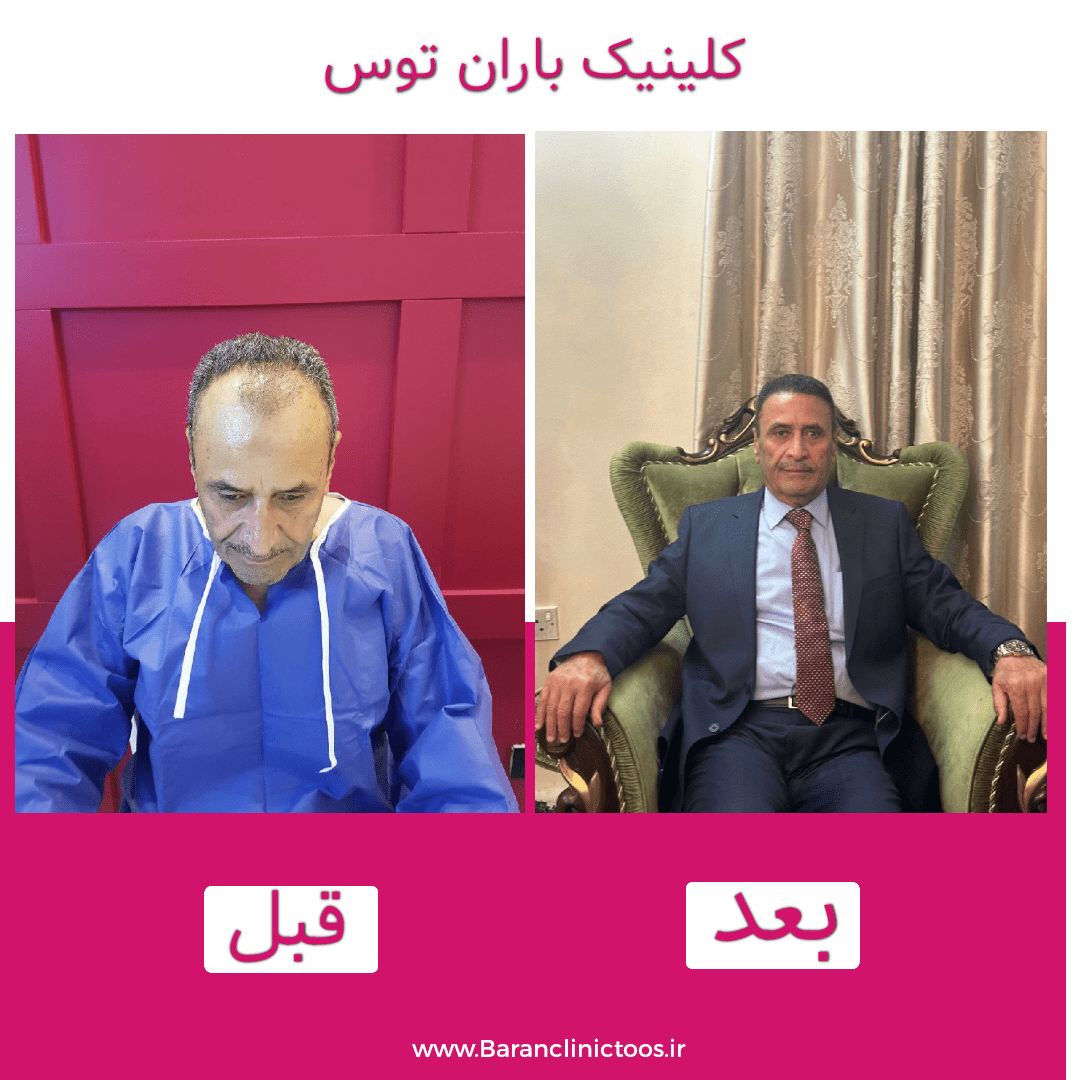 قبل و بعد کاشت مو